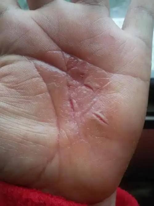 我手掌心奇痒开裂硬皮