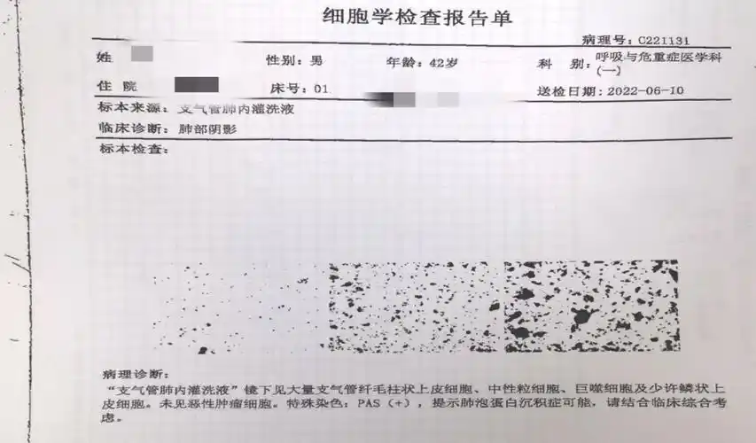 西安市胸科医院:罕见!中年男子肺里洗出17升"牛奶"
