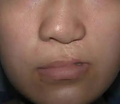 唇裂二期修复手术主要包括哪些余文林解答