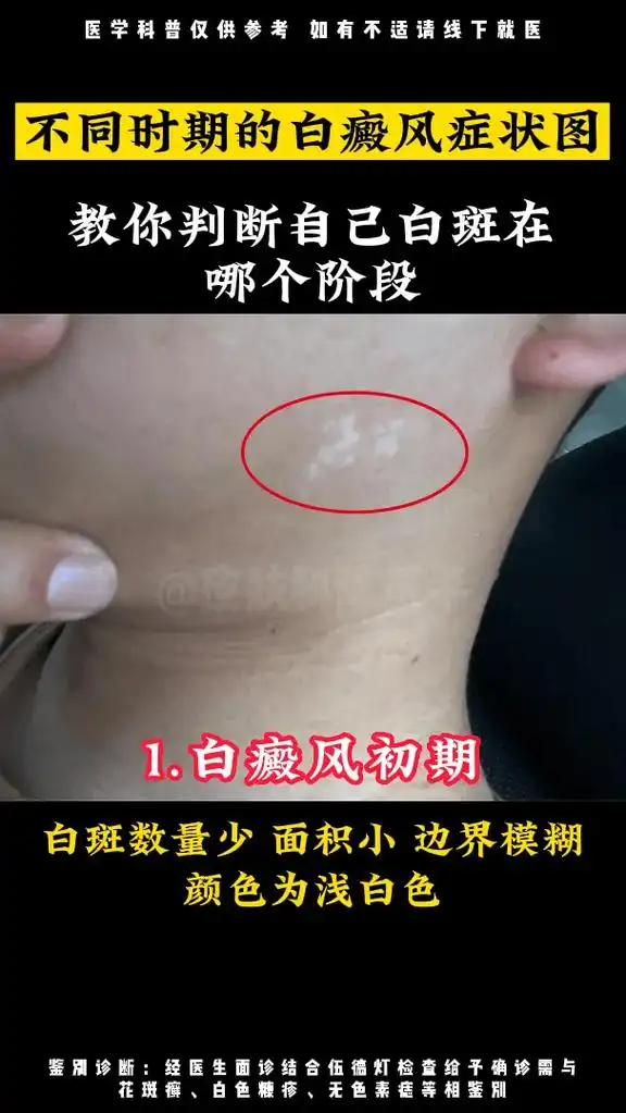不同时期的白癜风症状图.