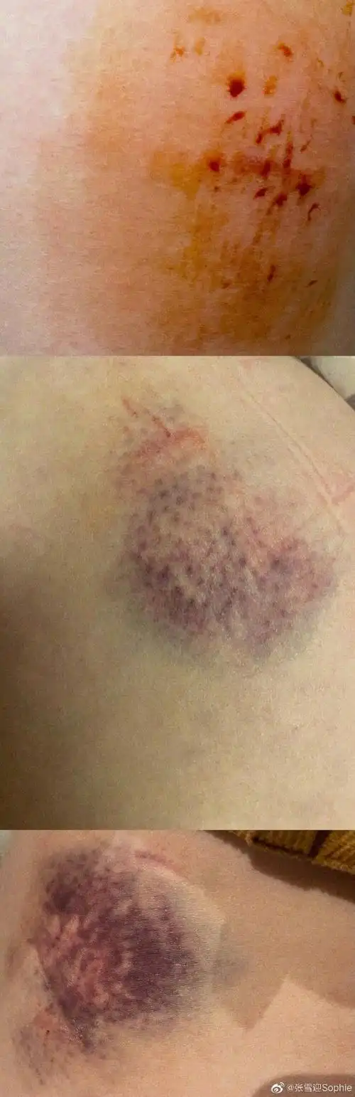 张雪迎晒照清纯甜美颜值高受伤照片触目惊心引人心疼