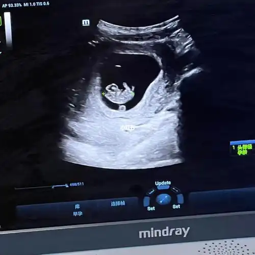 昨晚上厕所出来一滴新鲜的血在白带里面,冒着风险去医院打了个彩超