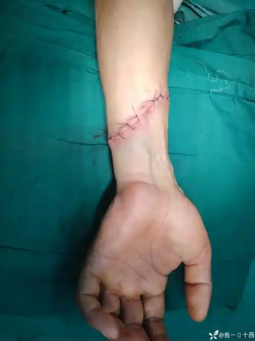 小武日记之一例幸运的切割伤