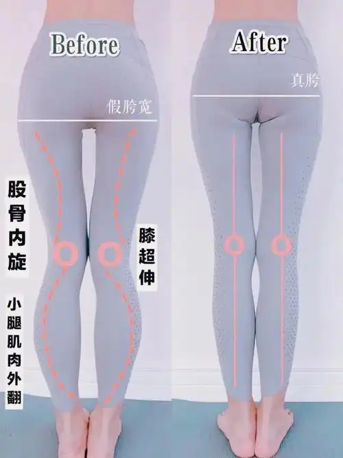 大腿股骨在髋关节囊发生股骨大转子半脱臼,把两侧的肌肉顶的又高又紧