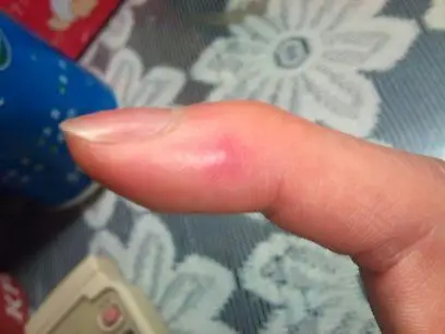 左手食指左侧出现个泡,不知道是不是被热水烫的?求处理方法