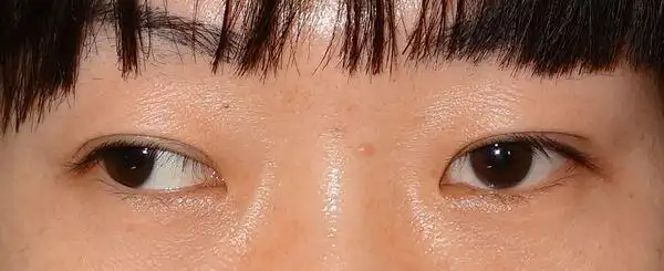 外斜视是指眼球向外偏斜.它与内斜视相反.