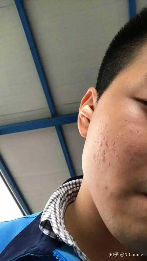 还有救吗?全脸都是痘坑,资深麻子脸.怎么办呀555?