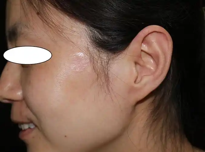 面部多个色素痣手术切除后4月复诊一例 - 好大夫在线