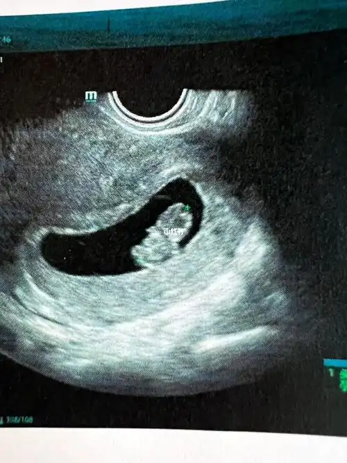 孕8周5今天也是符合孕周的一天