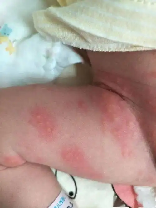 护理专题丨新生儿常见生理现象