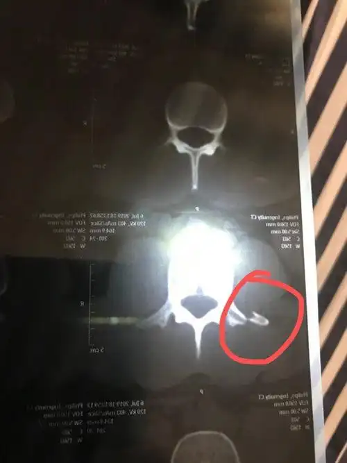 腰3椎体右侧横突骨折能够评伤残吗?