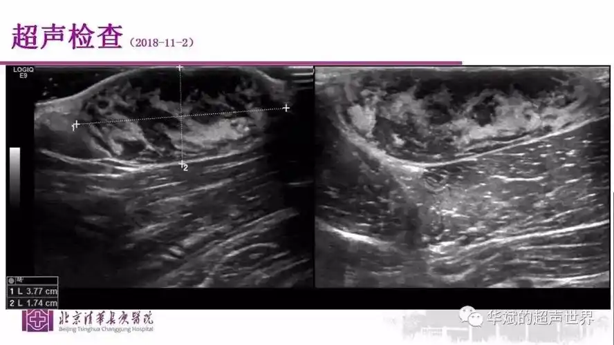 病例讨论及文献学习:隆突性皮肤纤维肉瘤