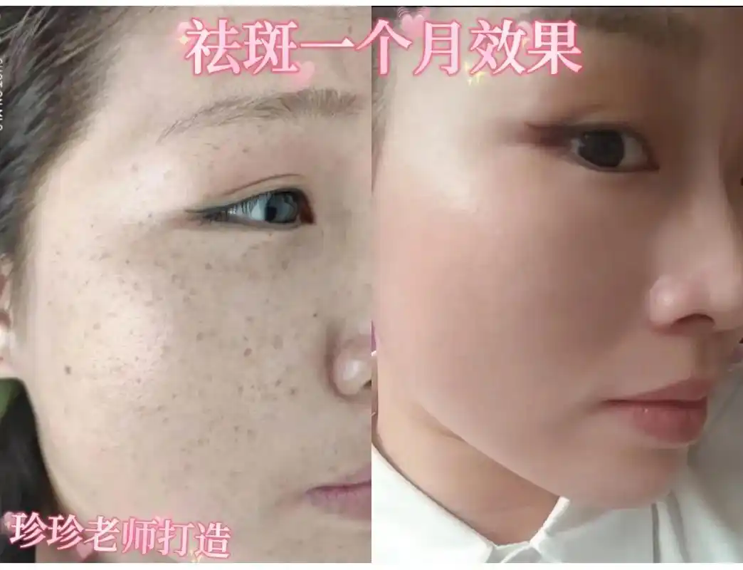 你知道为什么你涂抹再多产品都祛不掉吗[撇嘴]照片是本人祛斑 - 抖音
