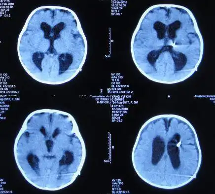 5个月婴儿脑积水出现头颅增大双眼落日征发育迟缓在脑脊液科获得早期