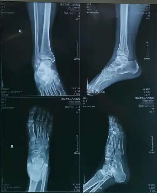 58岁双踝关节骨折内固定手术一例