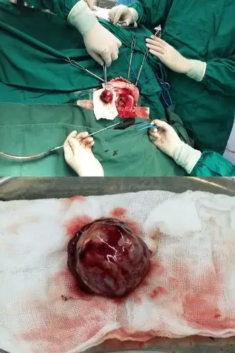 子洲县中医院神经外科成功为一名额叶巨大脑瘤患者行手术治疗