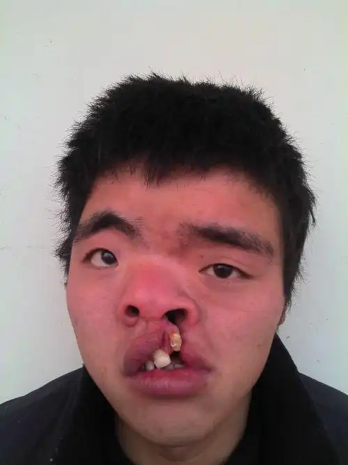 我先天性唇腭裂!特别的严重,家家医院都要好几万快!家里没钱,怎么办?