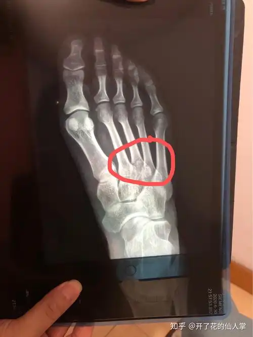 跖骨3.4基底骨折 - 知乎