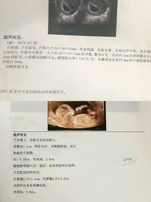 孕囊椭圆形的很多人说是女孩昨天nt了是男孩哦