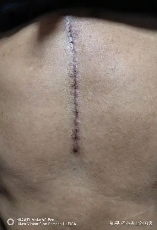 小切口心脏手术