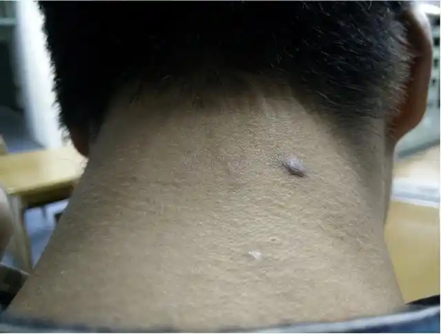 外观常呈菜花状,早期是红色硬结,后面会发展成疣状