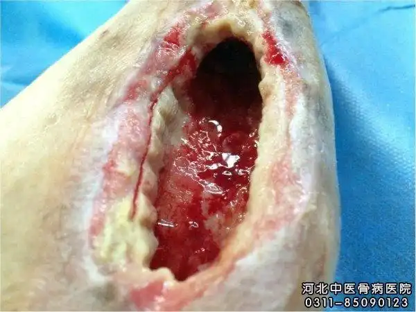 慢性骨髓炎的原因和临床表现