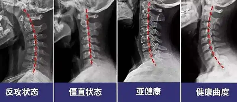 有多少人体检的时候被告知,颈椎有点变形?