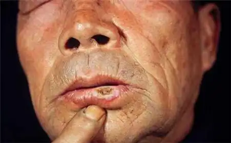 皮肤癌的症状有那些?怎样判断是否得了皮肤癌?