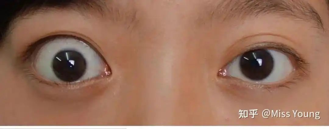 戴眼镜会不会让眼睛变突?