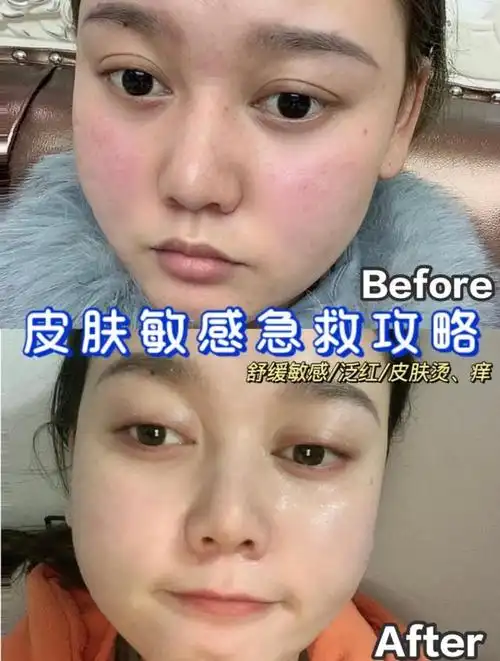 敏感肌舒缓攻略分享