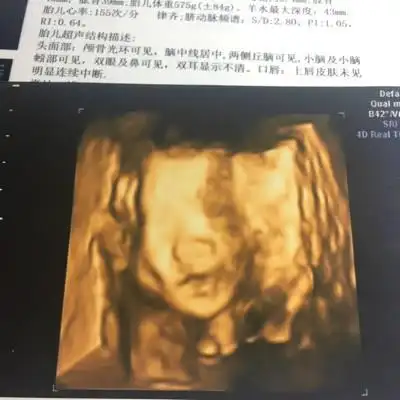 前两天做的四维,四维图上看起来正常,可是放大的照片看起来像兔唇,问