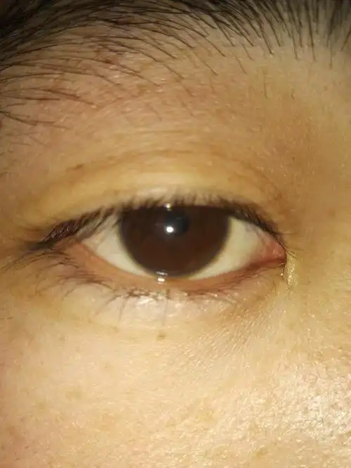 眼科#我这个瞳孔外伤性散大,但是今天发现边缘左下角不圆,这是巩膜