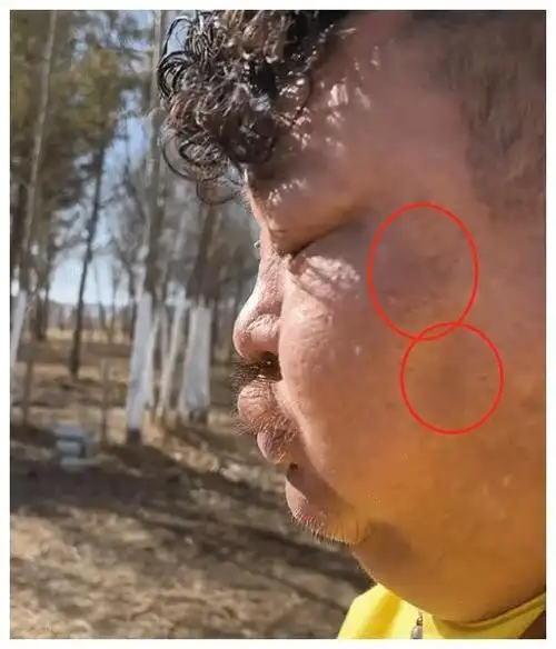 吃播界的"牛亡爷",网红恩克面部黑斑扩散,网友:脖子都没了