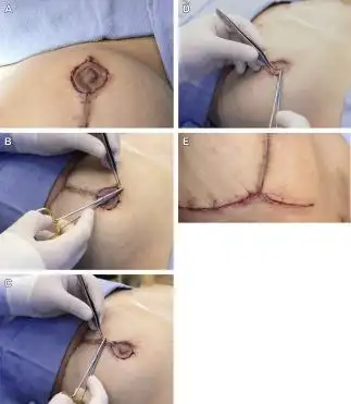 乳房缩小术,乳房提升固定术及其他整形领域的应用