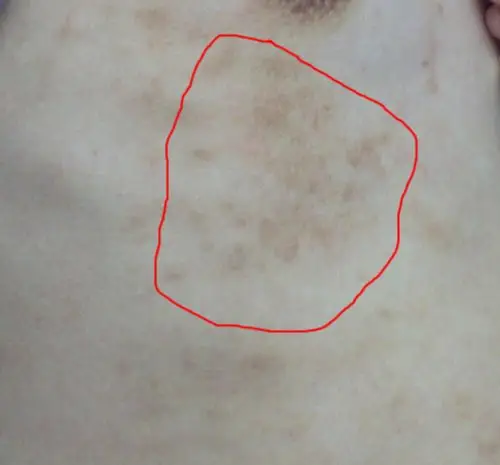 请懂皮肤的专家帮我看下!