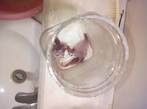 孕49天,肚子疼痛阴道流血,昨天下午突然特别疼然后流出来个东西,洗了