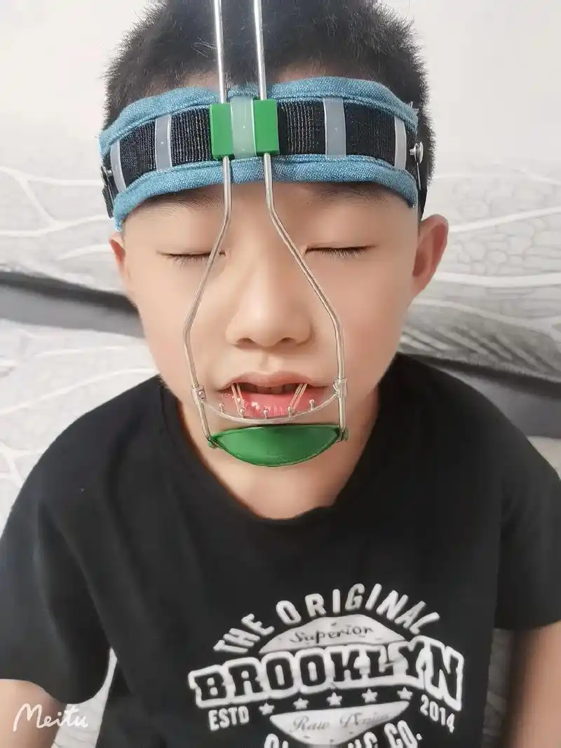 地包天第一天带矫正器 各种不舒服,难以入睡,以后每天晚上都戴 - 抖音