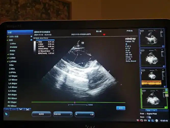 【讨论】求一份正式的心脏彩超报告