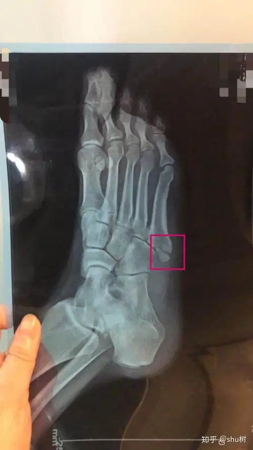 第五跖骨基底部骨折2020 - 知乎
