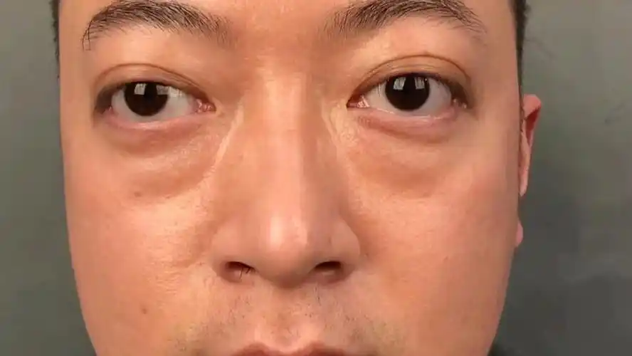 甲亢导致的凸眼对生活影响太大_哔哩哔哩_bilibili