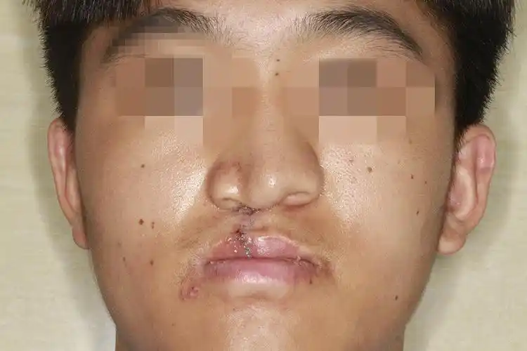 唇裂术后唇二期功能性整复原创