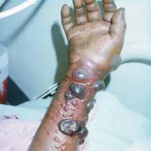 埃博拉出血热:临床表现