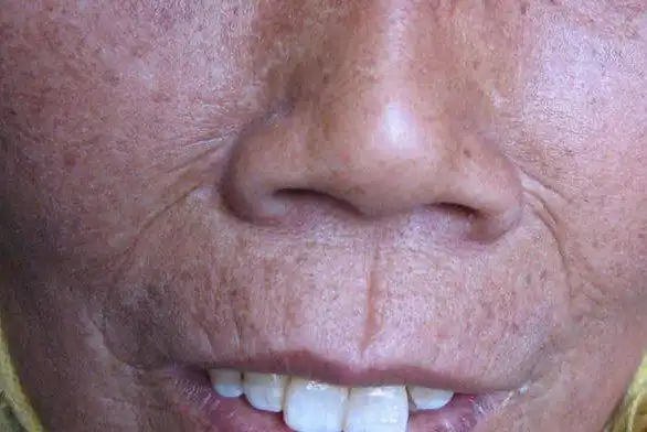 斑块状皮损数年后局部皮肤硬度减轻,萎缩变薄,留有色素沉着或减退