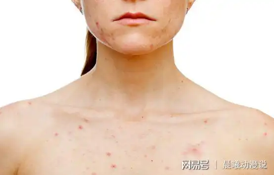 30岁女子胸口长"小红点",患上肝癌,医生:"1种菜"不能多吃