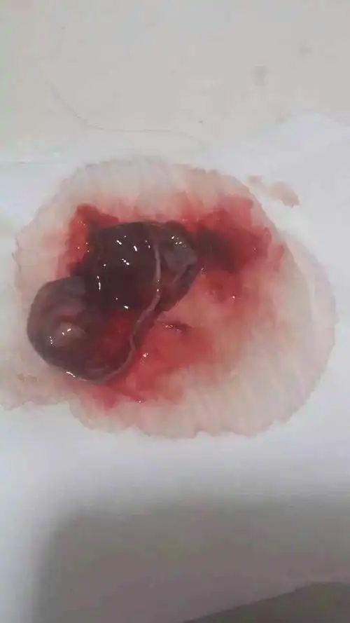 妇科宫颈糜烂排出物图片