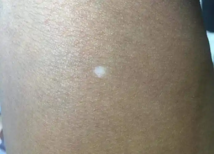 之所以还是称之为"特发性点状色素减退症",是因为这种白斑的特点臼乔