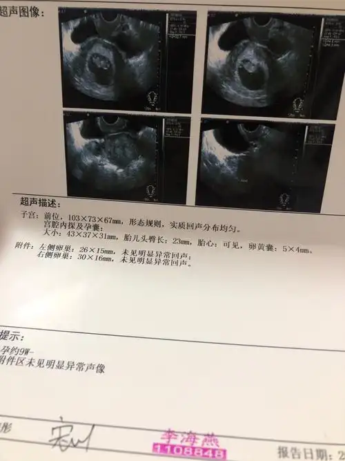 [试管婴儿]移植45天b超,弱弱的问一句孕