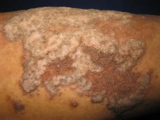 看图识病————慢性肥厚性湿疹