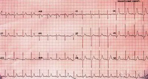 窦性心动过速心电图特征