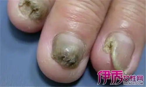 【图】慢性灰指甲图片大全 告诉你灰指甲的六大危害